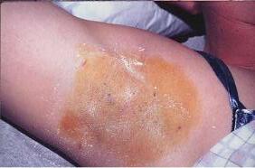 Иссечение кожи как метод избавления от гипергидроза