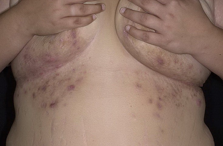 Воспалительные очаги гидраденита под грудью