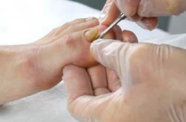 Обработка ногтей от грибка