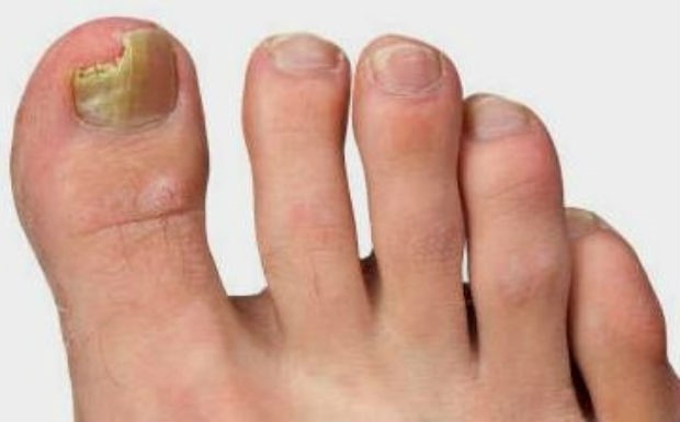 Лечение грибка на большом пальце ноги