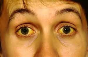 Синдром Жильбера - желтая кожа и белки глаз