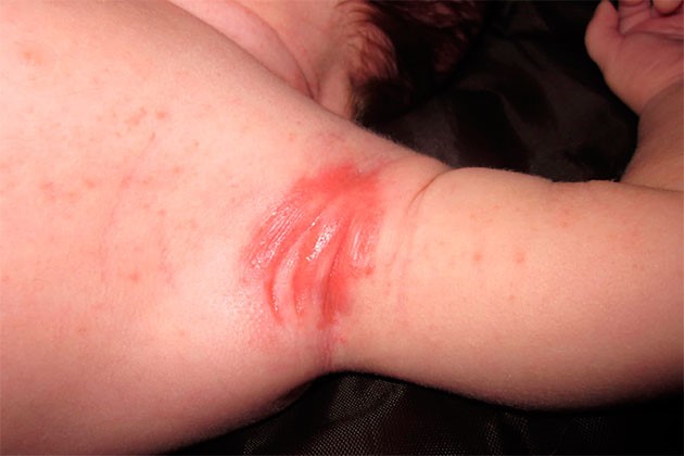 Потница у детей лечение в домашних условиях комаровский видео thumbnail