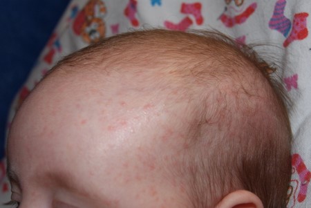Потница на голове у ребенка 2 года thumbnail
