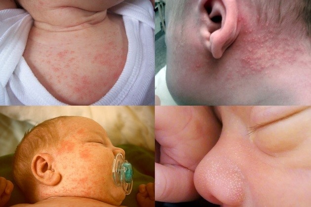 Аллергия на антибиотики или потница thumbnail