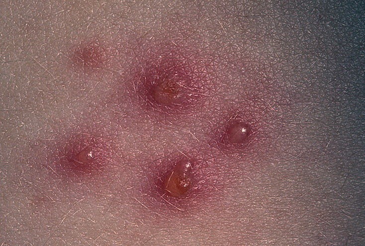 Потница или аллергия как отличить у взрослых thumbnail