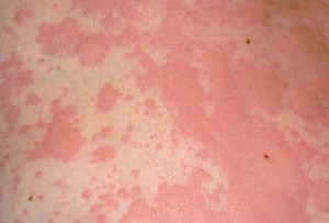 Аллергия или потница на животе thumbnail