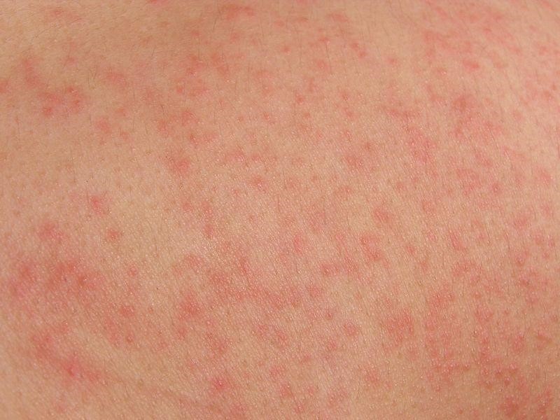 Аллергия сыпь потница отличия thumbnail